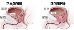 南阳治疗前列腺钙化哪家医院好？