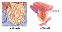 南阳治疗前列腺囊肿多少钱？
